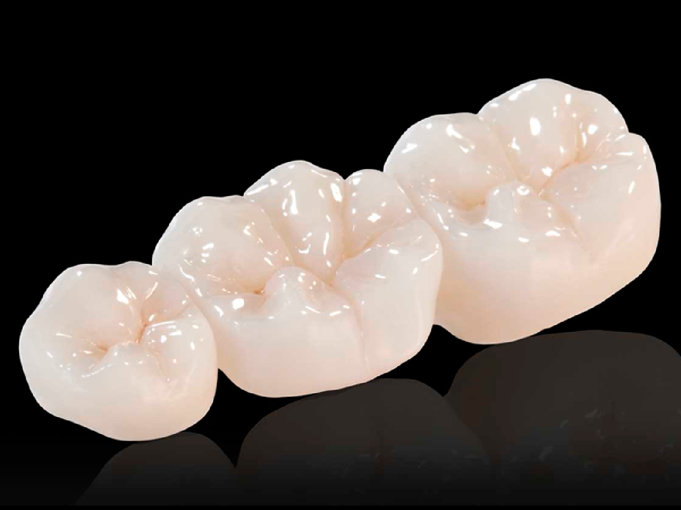 Crowns & Bridges - TruBlu Dentistry