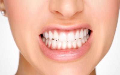 Teeth Grinding (Bruxism)