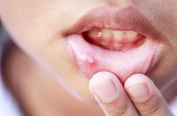 Canker Cold Sores
