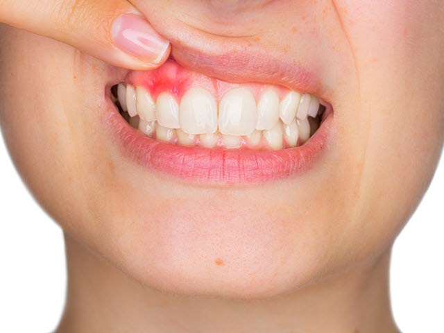 Gum Disease Gingivitis