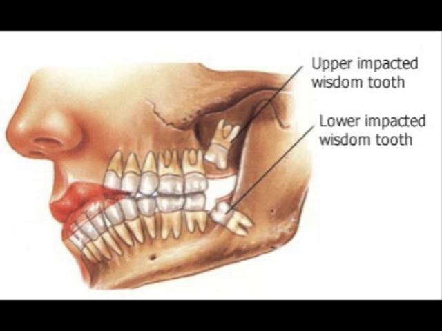 Impacted/Wisdom Teeth